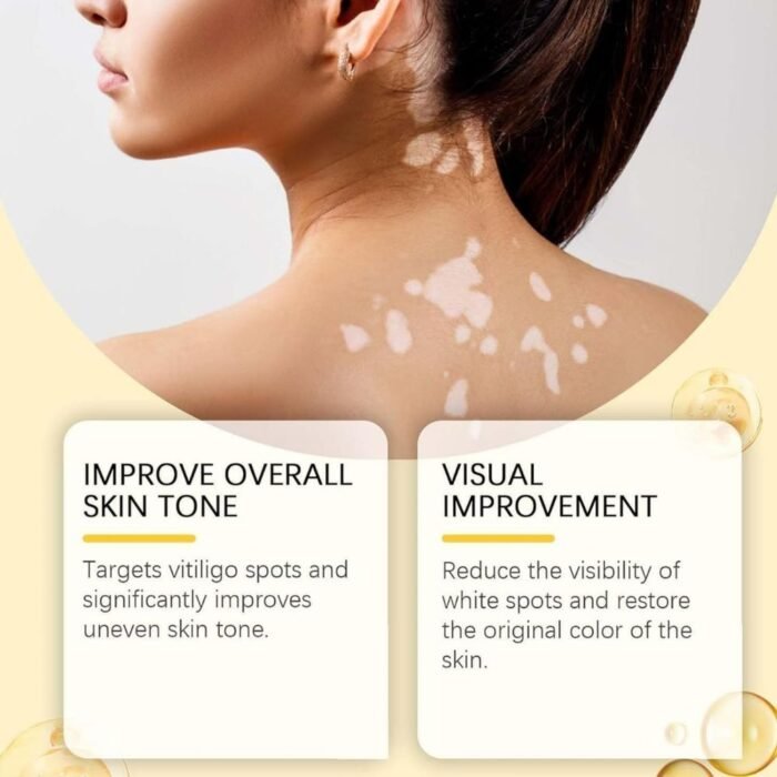 Vitigo Bee Venom Treatment Cream, Hydrating & Soothing Skin Care - Image 3