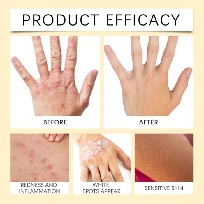 Vitigo Bee Venom Treatment Cream, Hydrating & Soothing Skin Care - Image 6